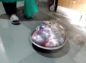 Une femme se fait retirer un kyste de l'ovaire de 24 kg  (Inde)